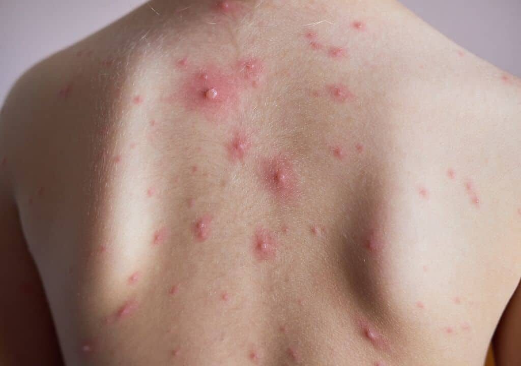 Hình ảnh người phụ nữ bị nổi mẫn ngứa ở lưng do gan