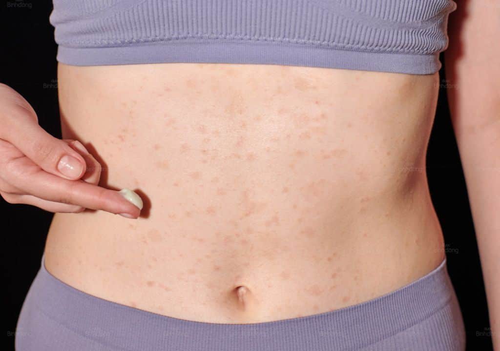 Hình ảnh về người phụ nữ đang bị nổi mẩn đỏ ở bụng nhưng không ngứa
