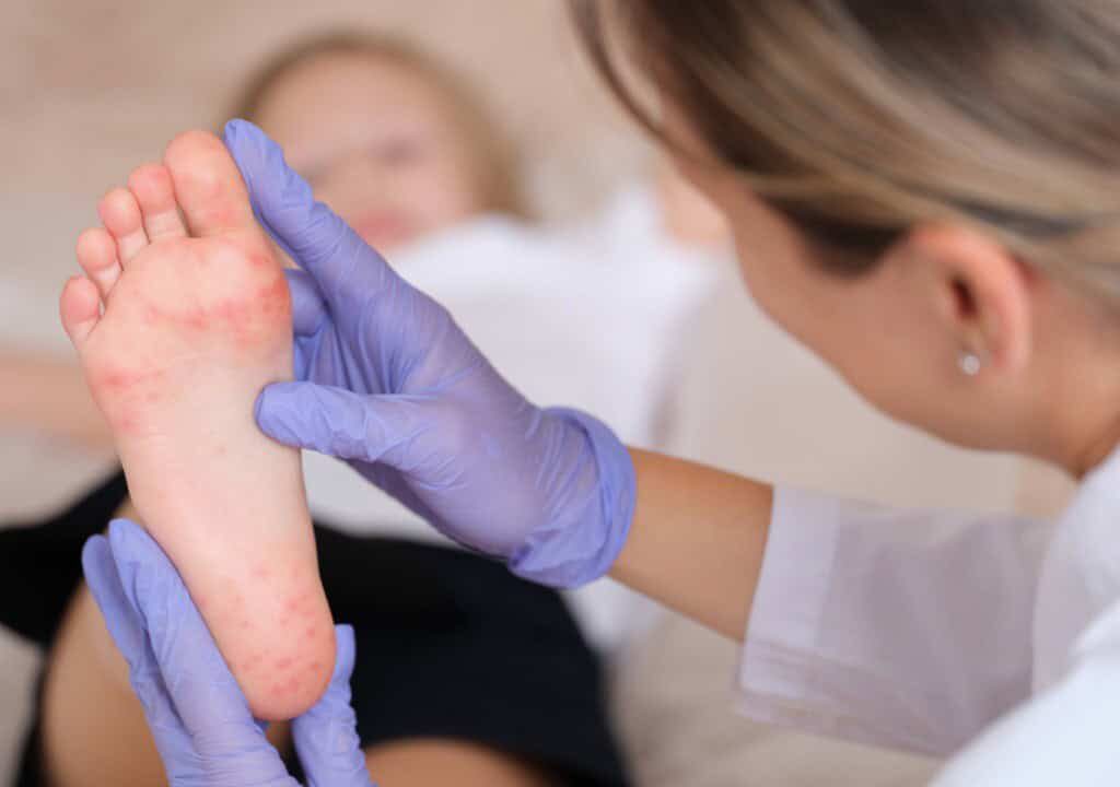 Hình ảnh em bé đang bị mẩn ngứa ở chân