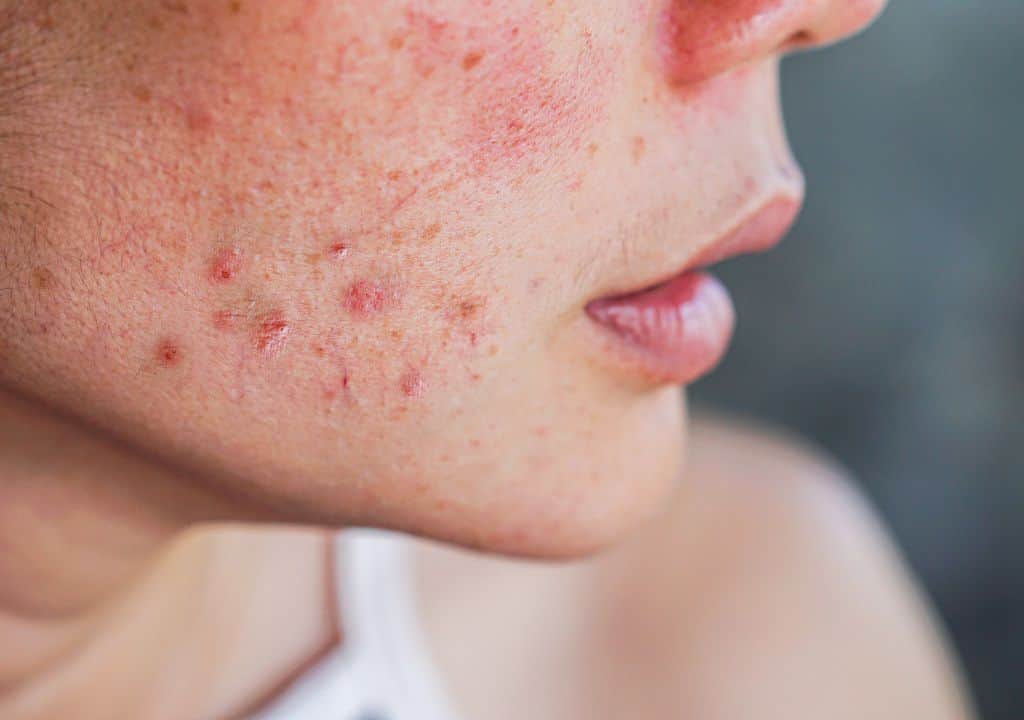 Hình ảnh người phụ nữ đang bị nổi mẩn ngứa do gan