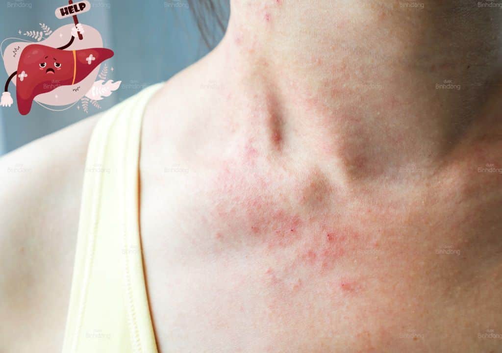 Hình ảnh người phụ nữ bị nổi mẩn đỏ ngay sau khi uống rượu