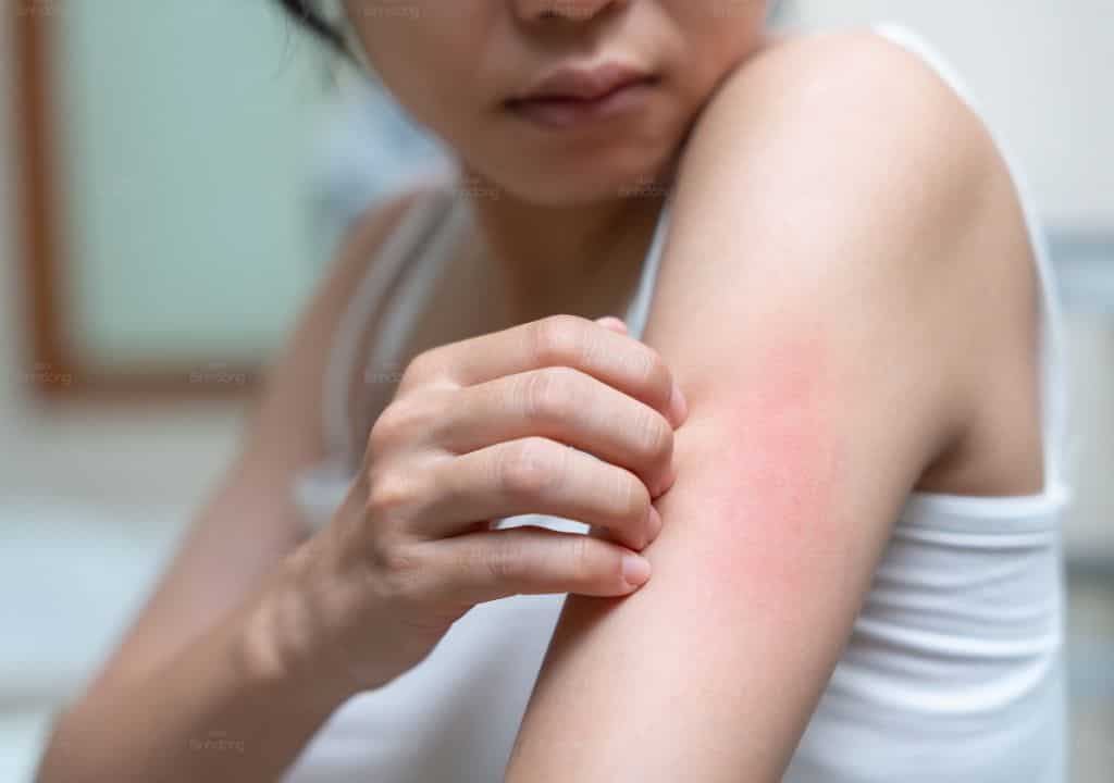 Hình ảnh người phụ nữ đang bị nổi mẩn đỏ ngứa khắp người