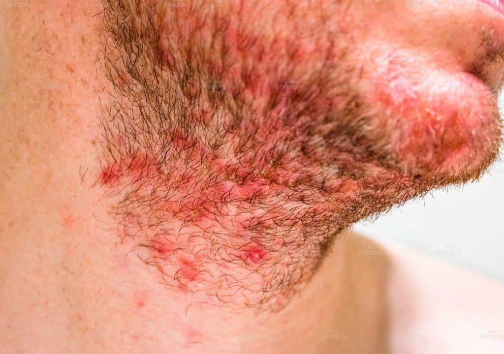 Hình ảnh người đàn ông đang bị nổi mẩn ngứa ở cổ