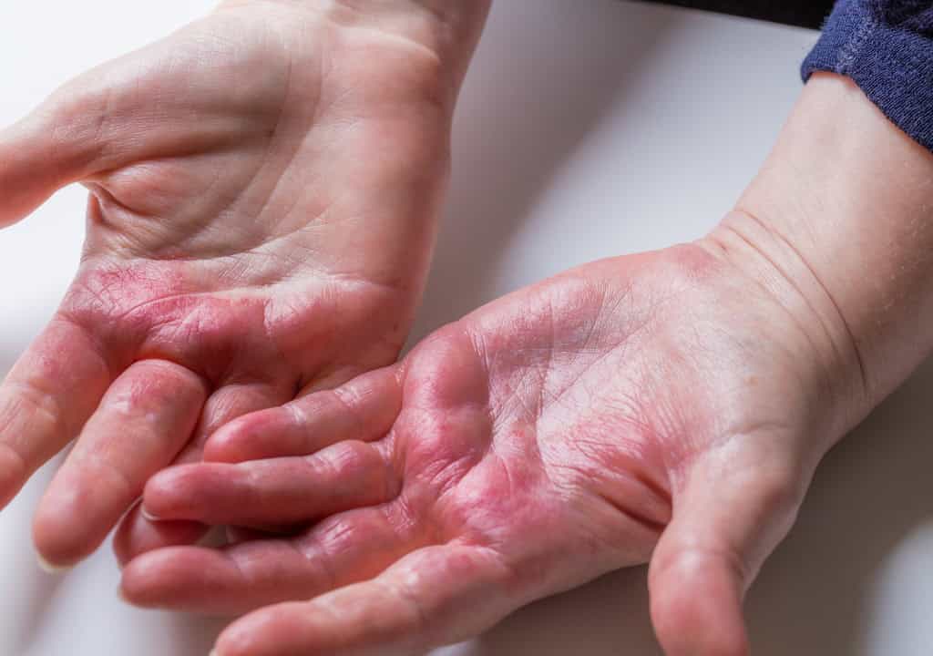 Hình ảnh về người đàn ông đang bị nổi mề đay ngứa về đêm