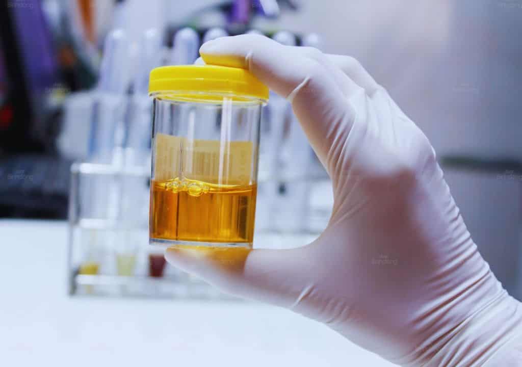 Hình ảnh về nước tiểu màu sẫm nguyên nhân xuất phát từ gan yếu