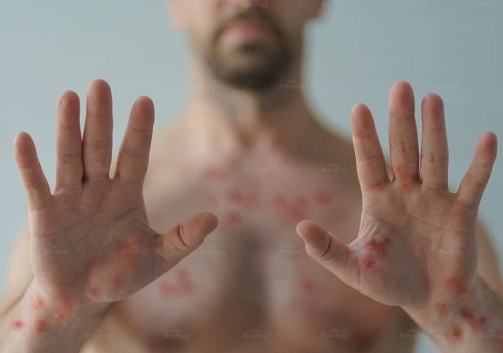 Hình ảnh người đàn ông đang bị nổi mẩn đỏ ngứa khắp người như muỗi đốt