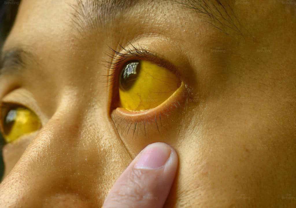 Hình ảnh người phụ nữ đang bị vàng mắt vàng da
