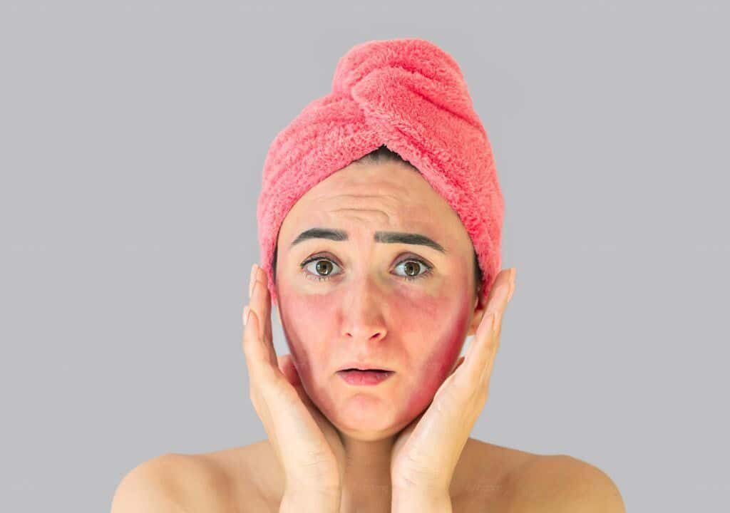 Hình ảnh ngườ phụ nữ đang bị mẩn ngứa ở mặt