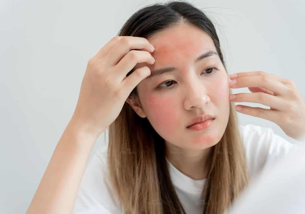 Hình ảnh ngườ phụ nữ đang bị mẩn ngứa ở mặt