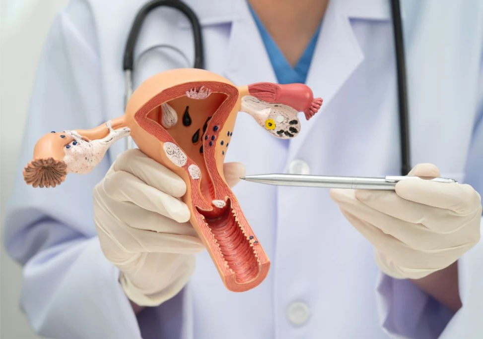 Hình ảnh về tử cung của người nữ đang có vấn đề do Rối loạn kinh nguyệt