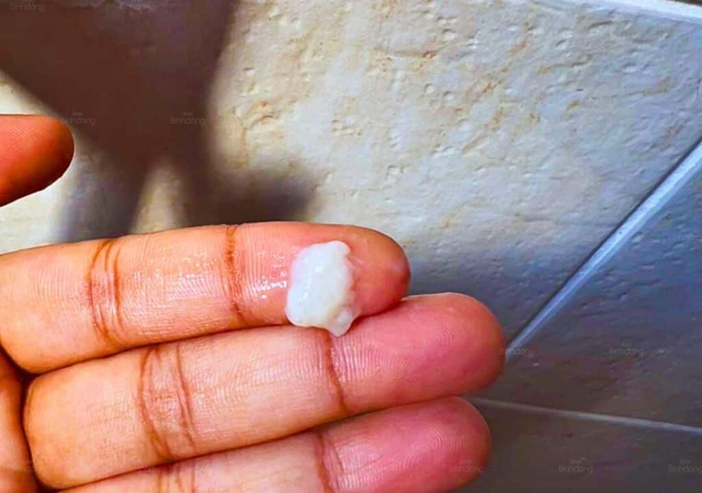 Hình ảnh về dịch màu trắng của phụ nữ