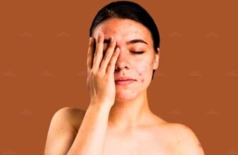 Hình ảnh người phụ nữ đang bị nóng trong người kèm nổi mụn