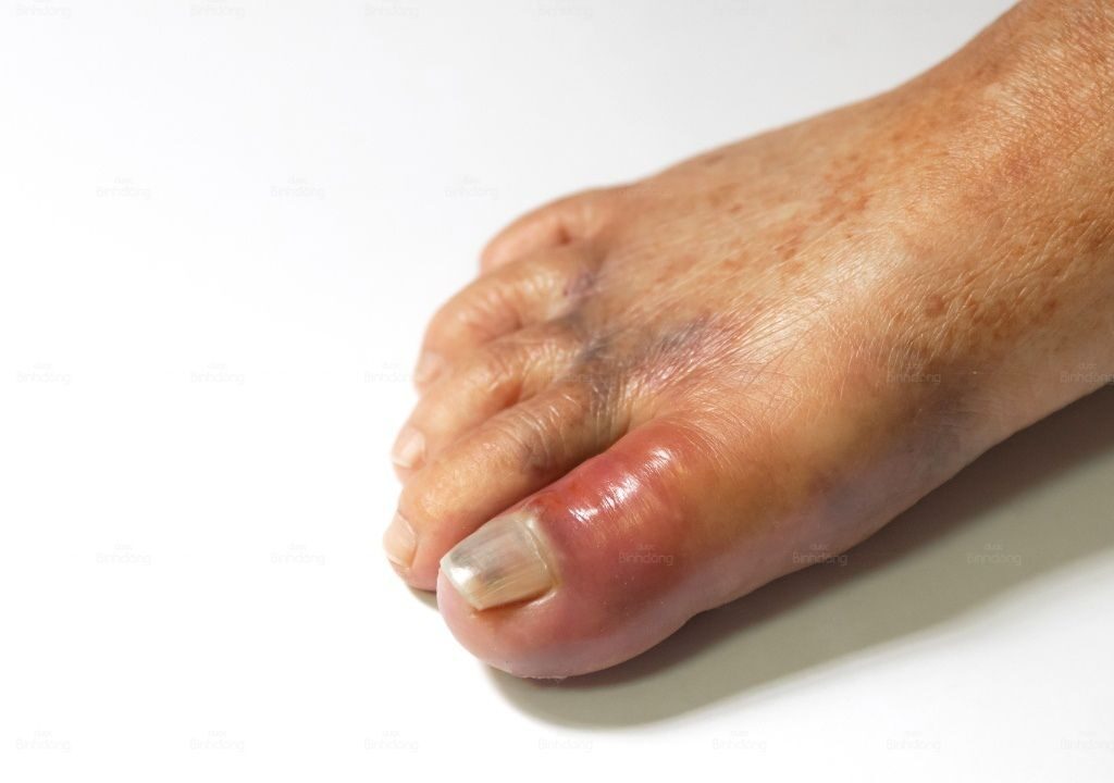 Hình ảnh người đàn ông bị sưng khớp chân