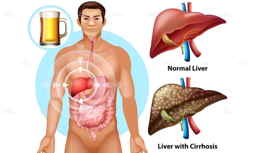 Rượu bia có thể gây tổn thương tế bào gan làm tăng men gan, suy giảm chức năng gan