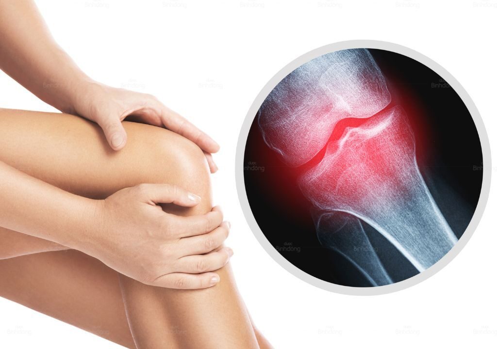 Hình ảnh người phụ nữ đang bị thoái hóa đa khớp