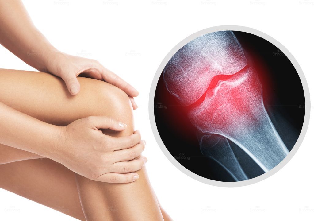 Hình ảnh người phụ nữ đang bị thoái hóa đa khớp