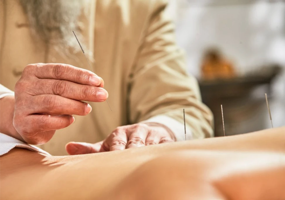 Hình ảnh bác sĩ đang châm cứu cho bệnh nhân