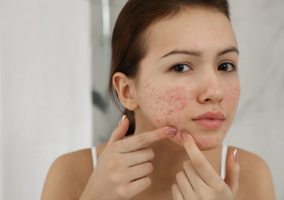 Người phụ nữ bị nổi mụn ở má