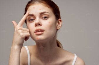 Thức khuya gây nổi mụn ở người trẻ