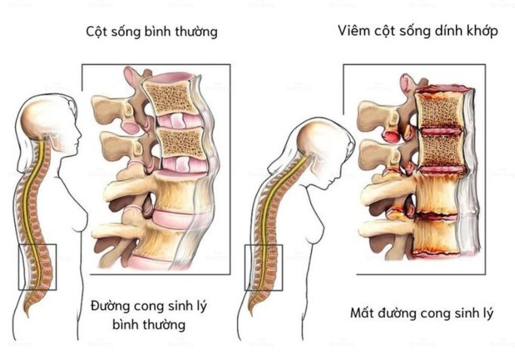 Ảnh mô tả đường cong sinh lý khi mắc các bệnh xương khớp - nguyên nhân tê bì chân tay