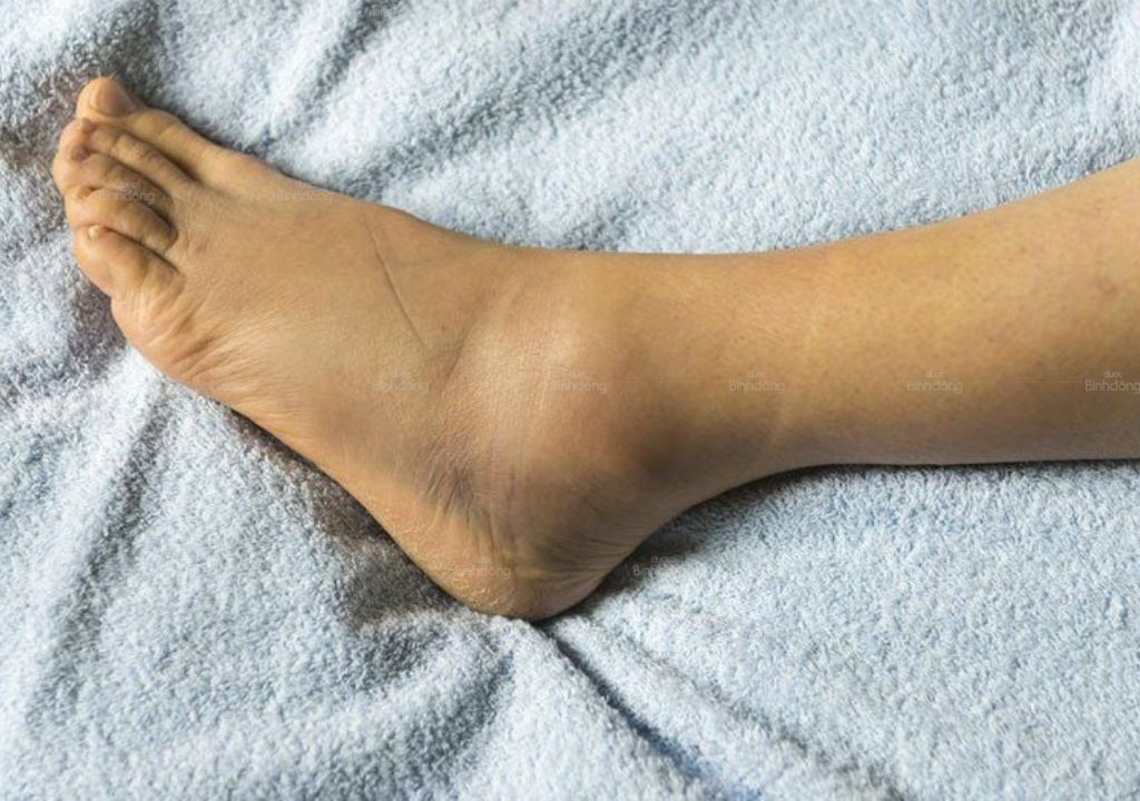 Ảnh chụp chân bị phù nề
