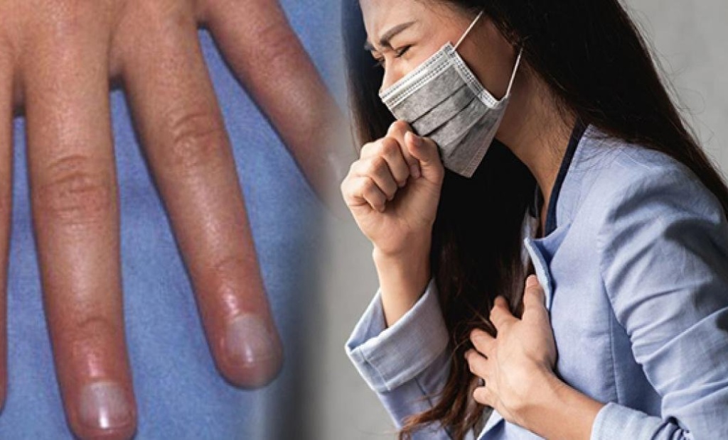 Môi và móng tay xanh tím là dấu hiệu nghiêm trọng cho thấy phổi đang suy yếu