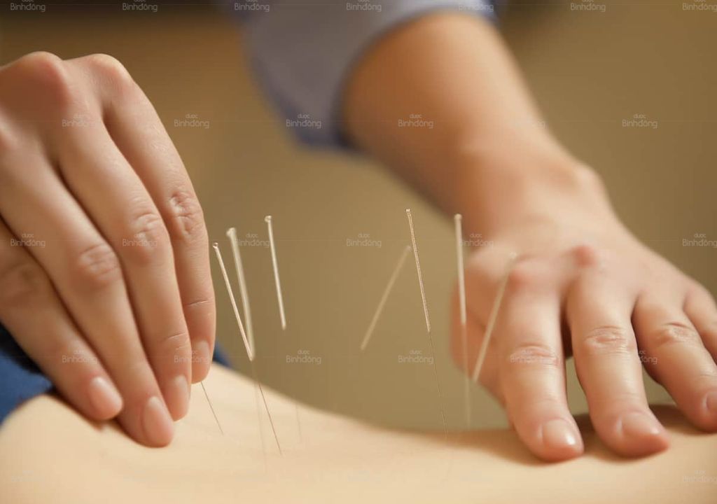 Hình ảnh châm cứu trong Đông Y giảm đau lưng