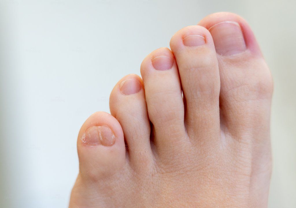 Hình chụp về ngón chân út