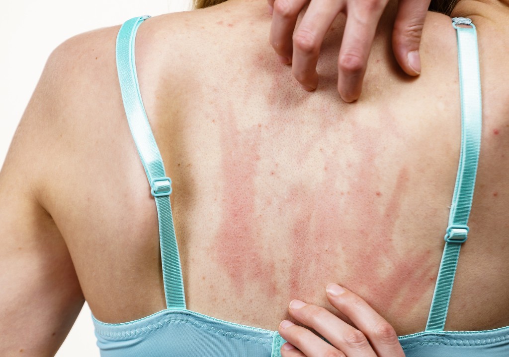 Người phụ nữ đang bị nóng gan mẩn ngứa ở lưng