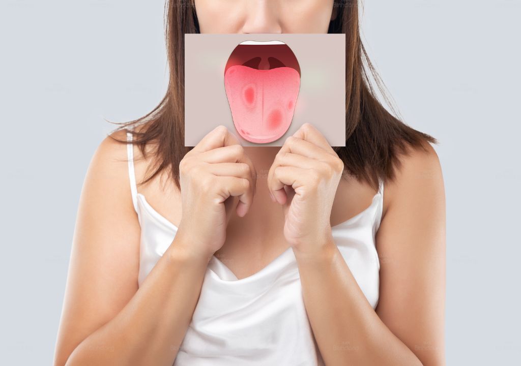 Hình chụp người phụ nữ đang bị nhiệt lưỡi