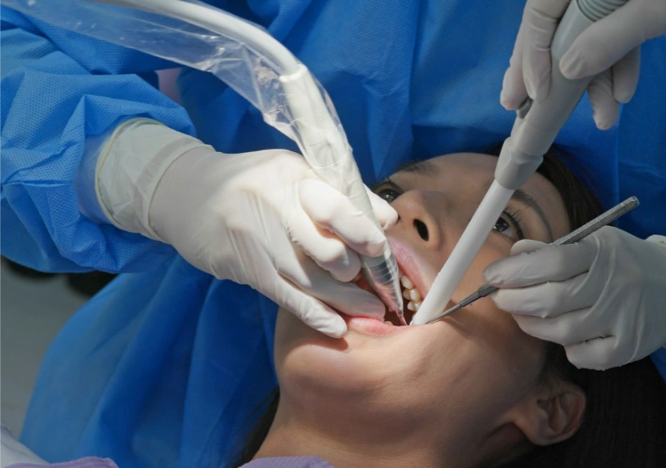 Hình chụp về hàm răng đang được cạo vôi răng