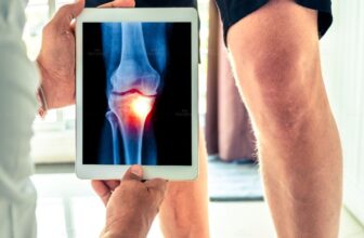 Hình chụp về khớp gối đang bị thoái hóa