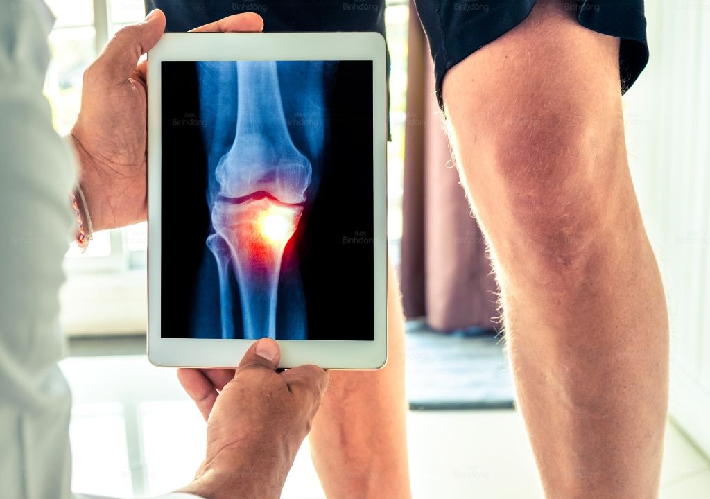 Hình chụp về khớp gối đang bị thoái hóa