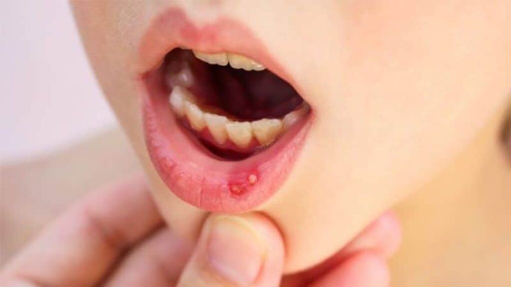 Trị nhiệt miệng ở trẻ em bằng cách sử dụng Liên Kiều dược liệu