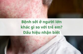 Bệnh sởi ở người lớn khác gì so với trẻ em? Dấu hiệu nhận biết
