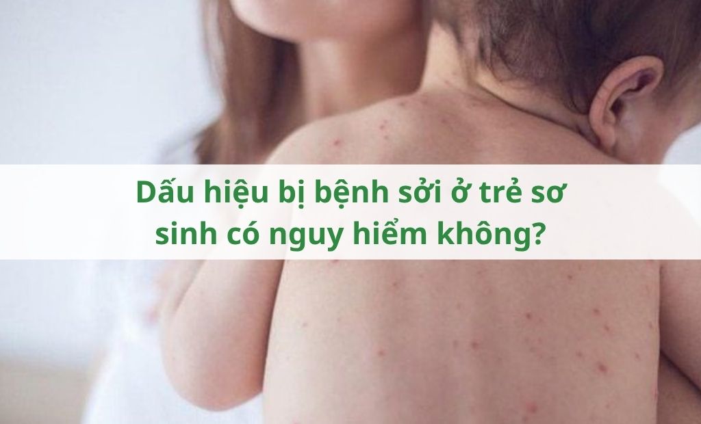 Dấu hiệu bị bệnh sởi ở trẻ sơ sinh có nguy hiểm không Dấu hiệu bị bệnh sởi ở trẻ sơ sinh có nguy hiểm không