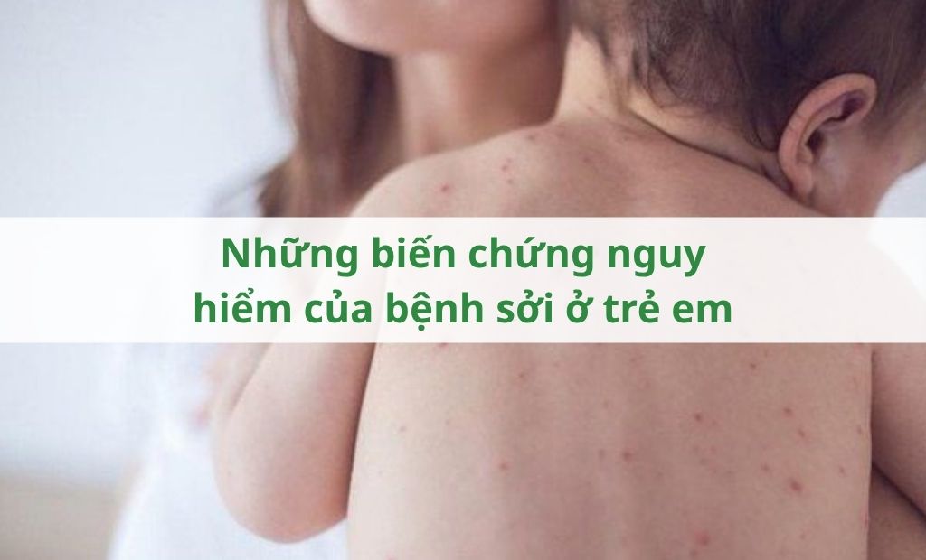 Những biến chứng nguy hiểm của bệnh sởi ở trẻ em Những biến chứng nguy hiểm của bệnh sởi ở trẻ em