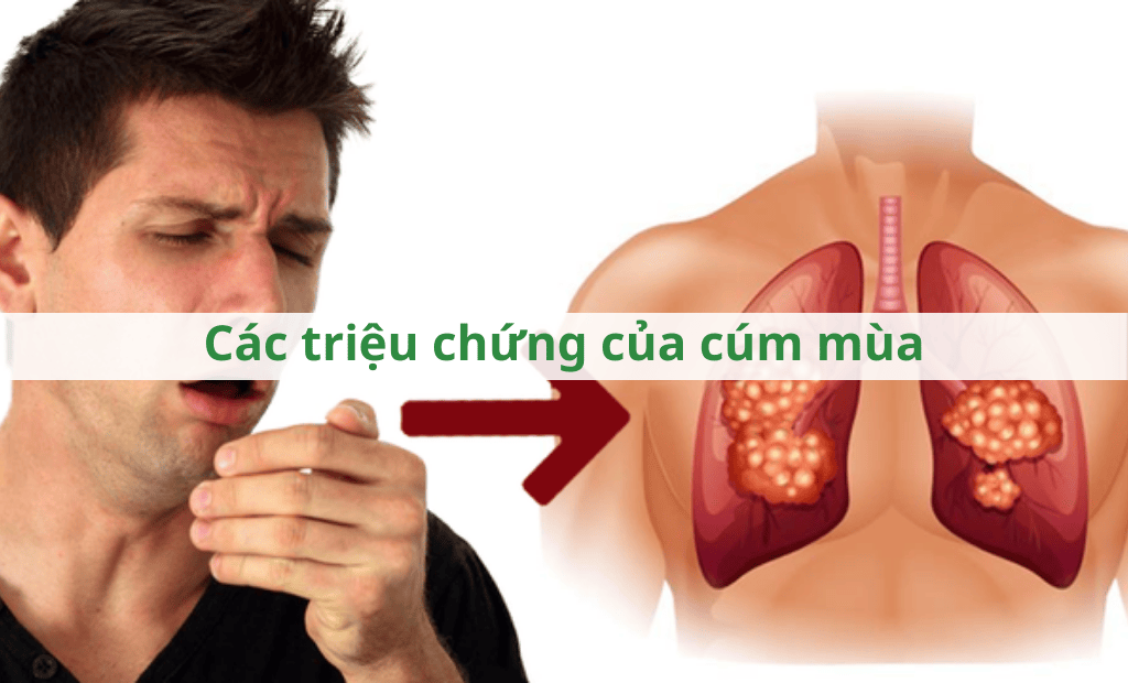 Các triệu chứng của cúm mùa Các triệu chứng của cúm mùa