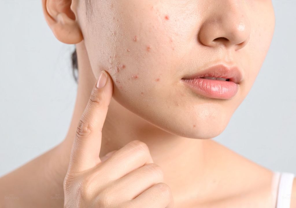 Nổi mụn trứng cá trên mặt khi tới tháng do nội tiết tố thay đổi