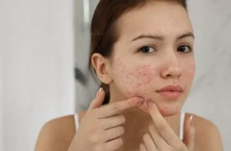Nổi mụn khi tới tháng do nội tiết tố thay đổi ở nữ giới