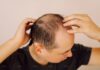 Người trung niên kiểm tra vùng tóc thưa và rụng nhiều trên đỉnh đầu.