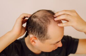 Người trung niên kiểm tra vùng tóc thưa và rụng nhiều trên đỉnh đầu.