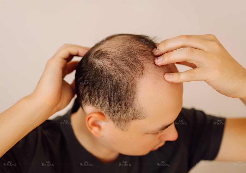 Người trung niên kiểm tra vùng tóc thưa và rụng nhiều trên đỉnh đầu.