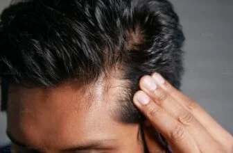 Người đàn ông kiểm tra vùng tóc thưa trên da đầu do rụng tóc kéo dài.