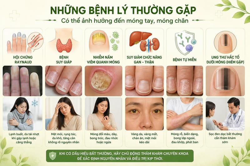 Những bệnh lý gây ra tình trạng móng tay giòn, dễ gãy