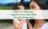 Bệnh sởi: Dấu hiệu, nguyên nhân, chẩn đoán và cách phòng ngừa