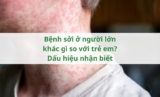 Bệnh sởi ở người lớn khác gì so với trẻ em? Dấu hiệu nhận biết