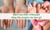 Bệnh tay chân miệng gia tăng: Phụ huynh cần làm gì?