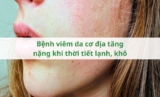 Bệnh viêm da cơ địa tăng nặng khi thời tiết lạnh, khô