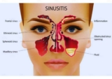 Viêm xoang: Nguyên nhân, chẩn đoán và cách điều trị hiệu quả
